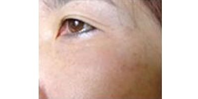 玻尿酸去靜態(tài)紋術(shù)后