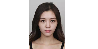 玻尿酸豐蘋(píng)果肌術(shù)前