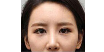 膠原蛋白填充淚溝術后