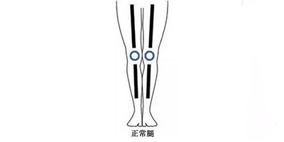 膝內(nèi)翻矯正術(shù)后