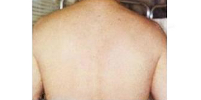 背部脫毛術(shù)后