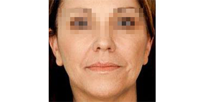 玻尿酸去面部細紋術前