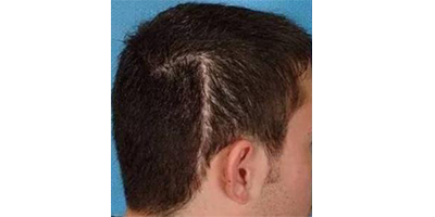 疤痕種植術(shù)前