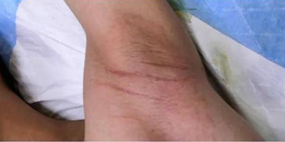 黃金微針除腋臭術(shù)后