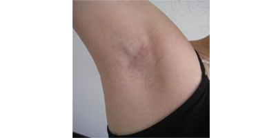 手術(shù)除腋臭術(shù)前