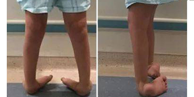 馬蹄足矯正術(shù)前