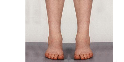 長(zhǎng)短腿矯正術(shù)后