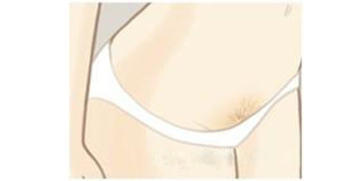 比基尼線脫毛術(shù)后