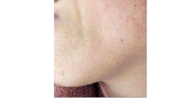 脫絡(luò)腮胡術(shù)后