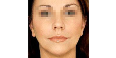 玻尿酸去面部細紋術后