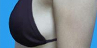 自體脂肪隆胸術(shù)前