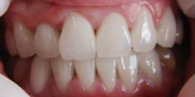 合金烤瓷牙術(shù)后