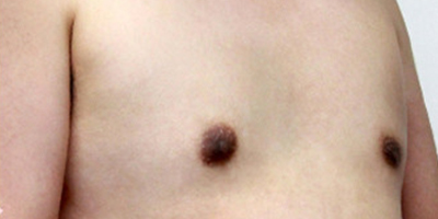 男性乳房肥大矯正術(shù)后