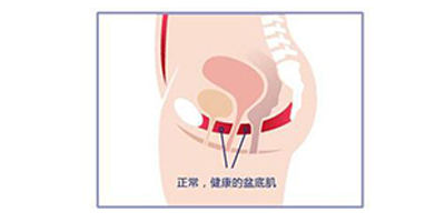 盆底肌修復(fù)術(shù)后