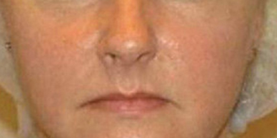 深藍(lán)射頻術(shù)后