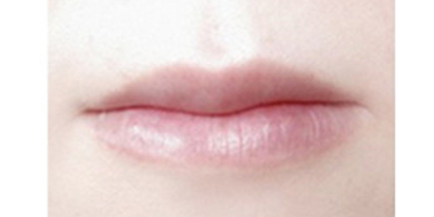 M唇手術(shù)術(shù)前