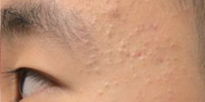 杏仁酸煥膚術前