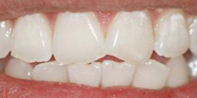 冷光美白術(shù)后