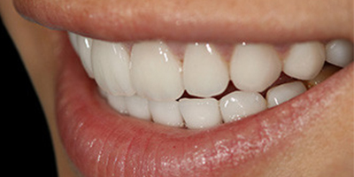 牙齒拋光術(shù)后