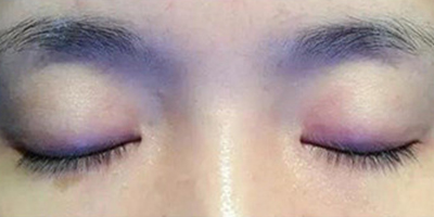 孕睫術(shù)術(shù)前