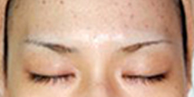 伊膚泉微針術(shù)后