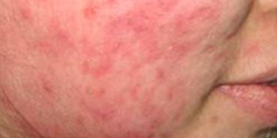 紅藍(lán)光祛痘術(shù)前