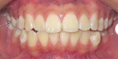 金屬托槽矯正術(shù)前