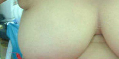 吸脂去副乳術(shù)前