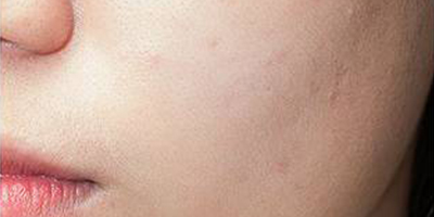 煥膚美白術(shù)前