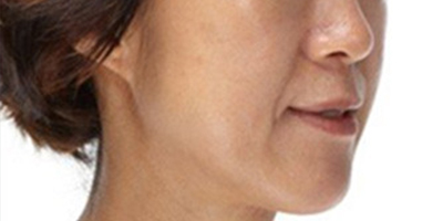 射頻緊膚術(shù)前