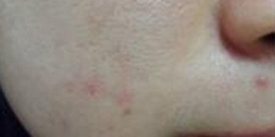 水楊酸煥膚術(shù)前