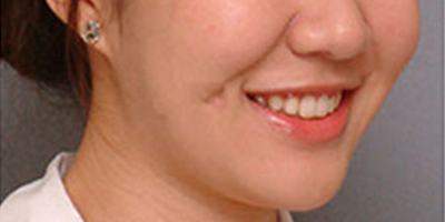 注射去露齦笑術(shù)后