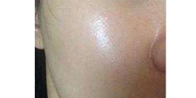 無(wú)針?biāo)庑g(shù)后