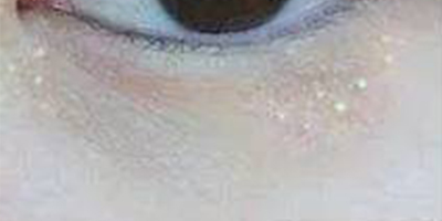 激光去脂肪粒術(shù)前