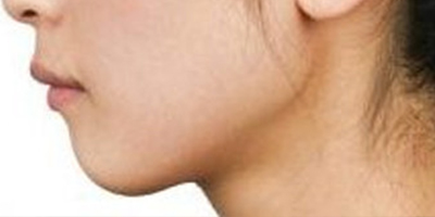 自體脂肪墊下巴術(shù)前