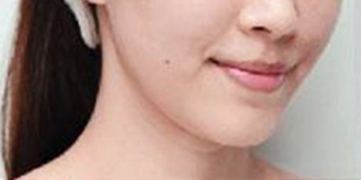 自體脂肪豐蘋果肌術前