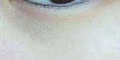 激光去脂肪粒術(shù)后