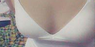 隆胸修復(fù)術(shù)后