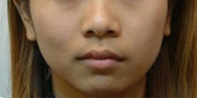 自體脂肪豐面頰術(shù)前