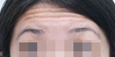 注射去面部細(xì)紋術(shù)前