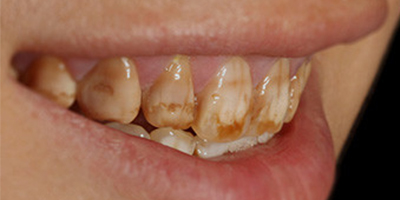 牙齒拋光術(shù)前