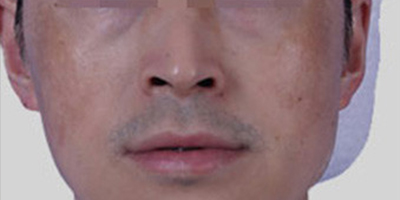 M22王者之冠術前