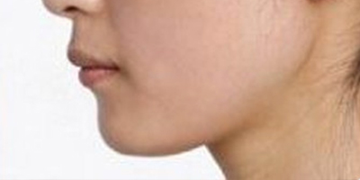 自體脂肪墊下巴術(shù)后