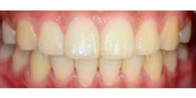 噴砂洗牙術(shù)前