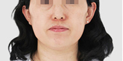 超聲提升術(shù)前