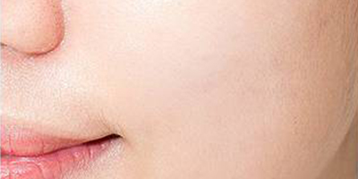 煥膚美白術(shù)后