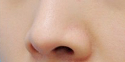 注射縮鼻頭術(shù)后