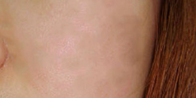 激光祛紅血絲術后