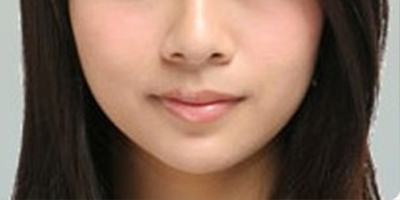 自體脂肪豐面頰術(shù)后