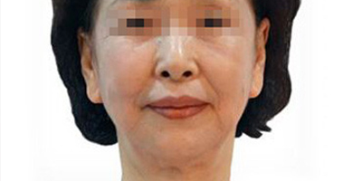 熱拉提術(shù)前